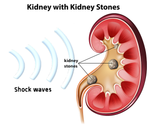 Extracorporeal Shockwave Lithotripsy (ESWL)