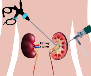 Laparoscopic Surgery