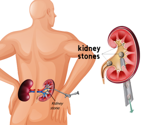 Percutaneous Nephrolithotomy (PCNL)