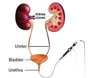 Renoscopy or Retrograde Intra-renal Surgery (RIRS)