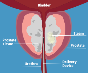 BPH Water Vapour Therapy