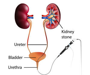 Ureteroscopy (URS)