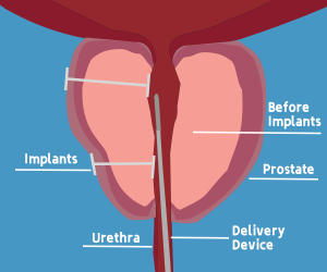 Urolift